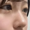 小鼻縮小（切開） / 鼻尖形成（非切開） ASTRA BEAUTY CLINIC AFTER サムネイル用