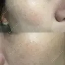 光治療（フォトフェイシャルなど） 小木曽クリニック DAY 5 サムネイル用