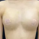 豊胸（脂肪注入） 湘南美容クリニック 吉祥寺院 DAY 7 サムネイル用