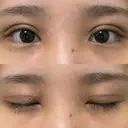 二重切開 / 目頭切開 オーキッド美容クリニック東京御徒町 DAY 14 サムネイル用