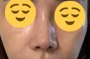 鼻尖形成（切開） / 鼻尖縮小 / 小鼻縮小（非切開） 銀座マイアミ美容外科 DAY 22 サムネイル用