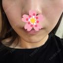 ハイフ（顔） しんゆり美容健康クリニック DAY 0 サムネイル用