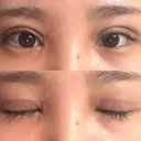 二重切開 / 目頭切開 オーキッド美容クリニック東京御徒町 DAY 15 サムネイル用