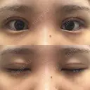 二重切開 / 目頭切開 オーキッド美容クリニック東京御徒町 DAY 16 サムネイル用