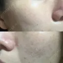 光治療（フォトフェイシャルなど） 小木曽クリニック DAY 8 サムネイル用