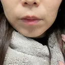 ハイフ（顔） 新宿中央クリニック DAY 8 サムネイル用