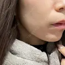 ハイフ（顔） 新宿中央クリニック DAY 8 サムネイル用