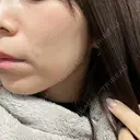 ハイフ（顔） 新宿中央クリニック DAY 8 サムネイル用
