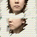 ヒアルロン酸注入（頬） / サーマクール 湘南美容クリニック 仙台院 DAY 0 サムネイル用