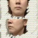 ヒアルロン酸注入（頬） / サーマクール 湘南美容クリニック 仙台院 DAY 2 サムネイル用