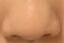 脂肪溶解注射（顔） 東京ロイヤルクリニック DAY 6 サムネイル用