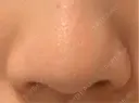 脂肪溶解注射（顔） 東京ロイヤルクリニック AFTER サムネイル用