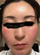 水光注射（ハリ・美肌） オラクル美容皮膚科 東京新宿院 DAY 0 サムネイル用