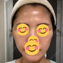 切開リフト 東京エビスクリニック AFTER サムネイル用