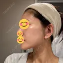 切開リフト 東京エビスクリニック DAY 39 サムネイル用