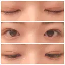 二重埋没 / その他（目元） / 上まぶたの脂肪取り 東京形成美容外科 船橋院 DAY 31 サムネイル用