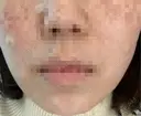 ほくろ・いぼ切除（肌） KARIS beauty clinic DAY 7 サムネイル用