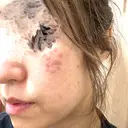 ハイフ（顔） / シミ取りレーザー / エレクトロポレーション 湘南美容クリニック 博多院 DAY 0 サムネイル用