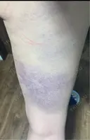 脂肪吸引（脚） 銀座マイアミ美容外科 DAY 3 サムネイル用