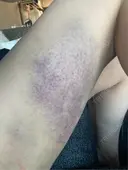 脂肪吸引（脚） 銀座マイアミ美容外科 DAY 4 サムネイル用
