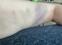 脂肪吸引（脚） 銀座マイアミ美容外科 DAY 7 サムネイル用