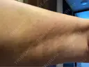脂肪吸引（脚） 銀座マイアミ美容外科 DAY 9 サムネイル用