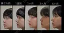 隆鼻術 / 鼻尖形成（切開） / 鼻中隔延長（切開） / 骨切幅寄せ / ワシ鼻修正・ハンプ切除 LUHO（ルホ）美容外科 DAY 180 サムネイル用