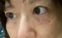 水光注射（ハリ・美肌） オラクル美容皮膚科 東京新宿院 AFTER サムネイル用