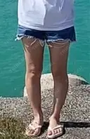 脂肪吸引（脚） 銀座マイアミ美容外科 DAY 140 サムネイル用