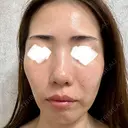 光治療（フォトフェイシャルなど） ミニマムスキンクリニック池袋 AFTER サムネイル用