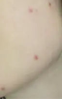 ほくろ・いぼ切除（肌） KARIS beauty clinic DAY 9 サムネイル用