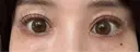タレ目形成・グラマラスライン（切開） アネシス美容クリニック AFTER サムネイル用
