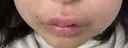 その他（口元） アネシス美容クリニック AFTER サムネイル用