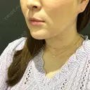 バッカルファット除去 / 脂肪吸引（顔） 湘南美容クリニック 秋葉原院 AFTER サムネイル用