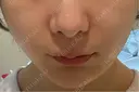 ヒアルロン酸注入（鼻翼基部） / 光治療（フォトフェイシャルなど） DMTC美容皮膚科 大宮院 AFTER サムネイル用