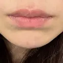 ヒアルロン酸注入（あご） 上野美容外科・美容皮膚科 AFTER サムネイル用