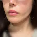 糸リフト / バッカルファット除去 / 脂肪吸引（顔） / ジョールファット除去 BLINC CLINIC （ブリンク クリニック） DAY 113 サムネイル用