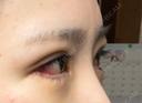 二重埋没 / タレ目形成・グラマラスライン（切開） エターナル美容クリニック DAY 7 サムネイル用