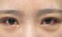 二重埋没 / タレ目形成・グラマラスライン（切開） エターナル美容クリニック DAY 9 サムネイル用