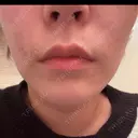 ボトックス（あご） / ボトックス（口角） MAクリニック 心斎橋 DAY 1 サムネイル用