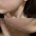 ハイフ（顔） しんゆり美容健康クリニック AFTER サムネイル用