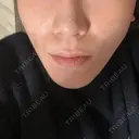 ボトックス（あご） / ボトックス（口角） MAクリニック 心斎橋 DAY 3 サムネイル用