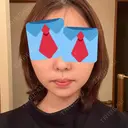 ジョールファット除去 / 脂肪吸引注射（顔） 湘南美容クリニック 大阪梅田本院 AFTER サムネイル用