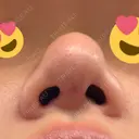 鼻尖形成（切開） / 軟骨移植 / 鼻尖縮小 / 鼻翼基部形成（貴族手術） / ヒアルロン酸注入（鼻翼基部） 東京シンデレラ美容外科 新宿院 DAY 20 サムネイル用