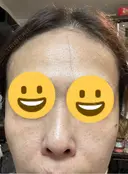 ピコレーザートーニング（美白・肝斑） / フラクショナルレーザー（毛穴・ニキビ跡） Mavie Beauty Clinic （マヴィービューティークリニック） DAY 4 サムネイル用