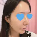 鼻尖形成（切開） / 小鼻縮小（切開） / ワシ鼻修正・ハンプ切除 / 鼻柱下降・鼻唇角形成（猫手術） ASTRA BEAUTY CLINIC DAY 9 サムネイル用