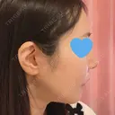 鼻尖形成（切開） / 小鼻縮小（切開） / ワシ鼻修正・ハンプ切除 / 鼻柱下降・鼻唇角形成（猫手術） ASTRA BEAUTY CLINIC DAY 9 サムネイル用