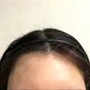 ヒアルロン酸注入（額） / ボトックス（眉間） PRO CLINIC プロクリニック 銀座院 AFTER サムネイル用