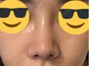 鼻尖形成（切開） / 鼻尖縮小 / 小鼻縮小（非切開） 銀座マイアミ美容外科 AFTER サムネイル用