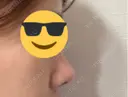 鼻尖形成（切開） / 鼻尖縮小 / 小鼻縮小（非切開） 銀座マイアミ美容外科 DAY 34 サムネイル用